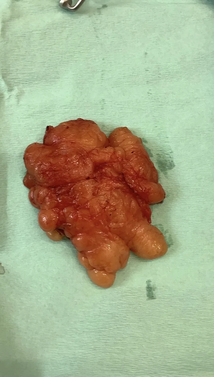 Lipoma removed intact