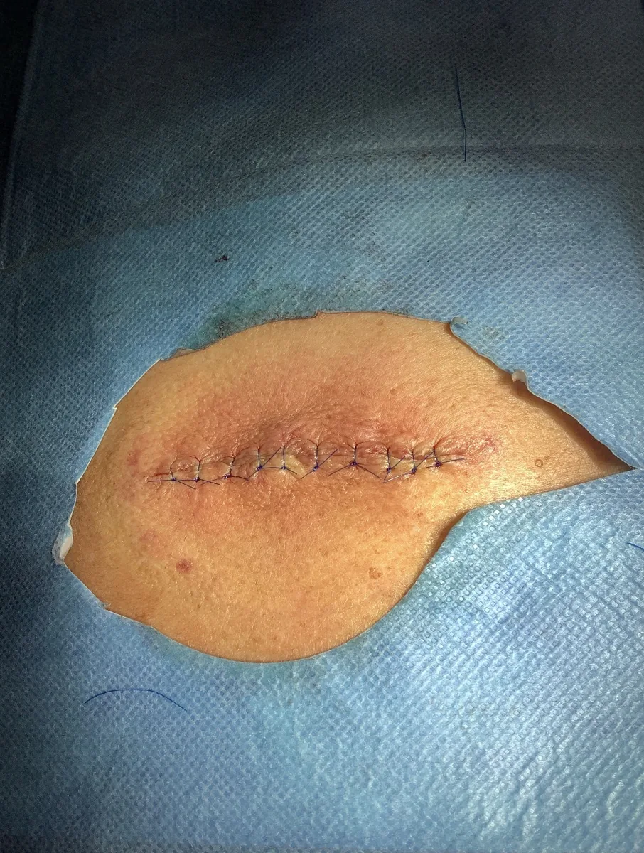Wound closure after lipoma removal