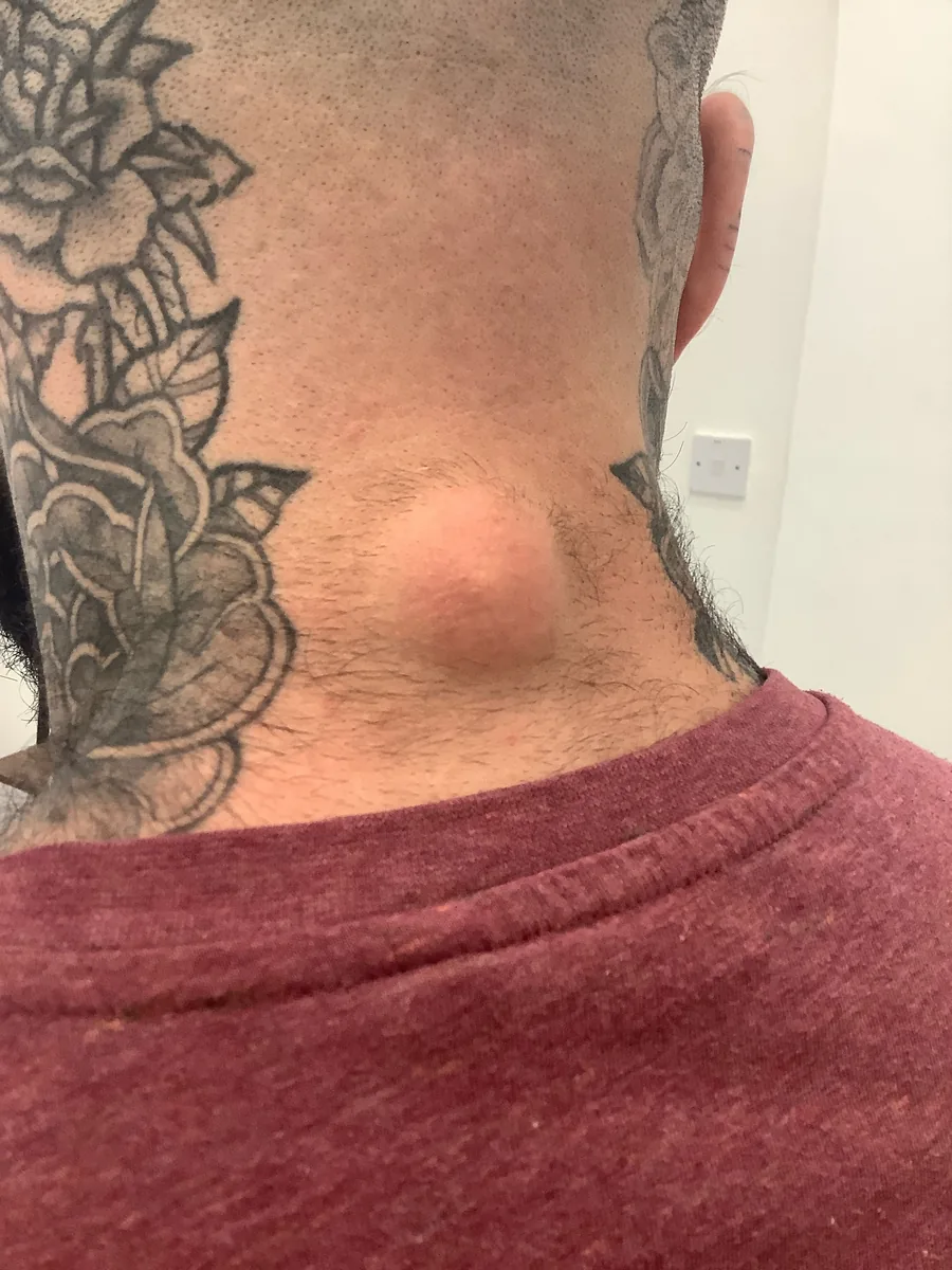 Cyst on the back of the neck before removal