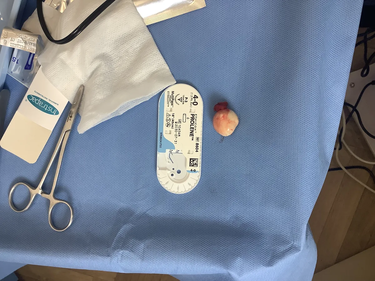 Neck cyst sac removed intact