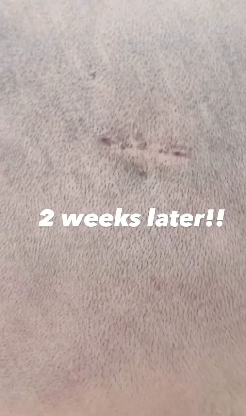 Scalp two weeks after lipoma removal