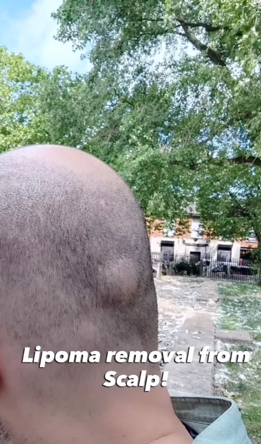 Scalp lipoma before removal