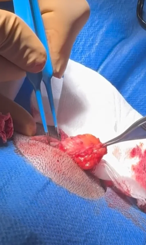 Scalp lipoma being removed